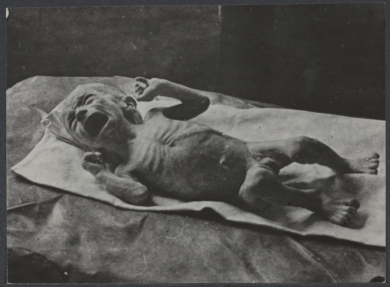 Unterernährtes Kind, schreiend, aus dem Winter Hungerwinter 1945