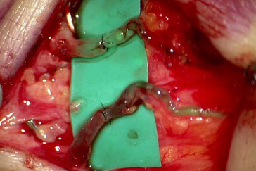 Mikrochirurgischer Eingriff: Anschluss eines Lymphgefässes an ein Blutgefäss. Jedes misst nur 0,8 Millimeter im Durchmesser.
