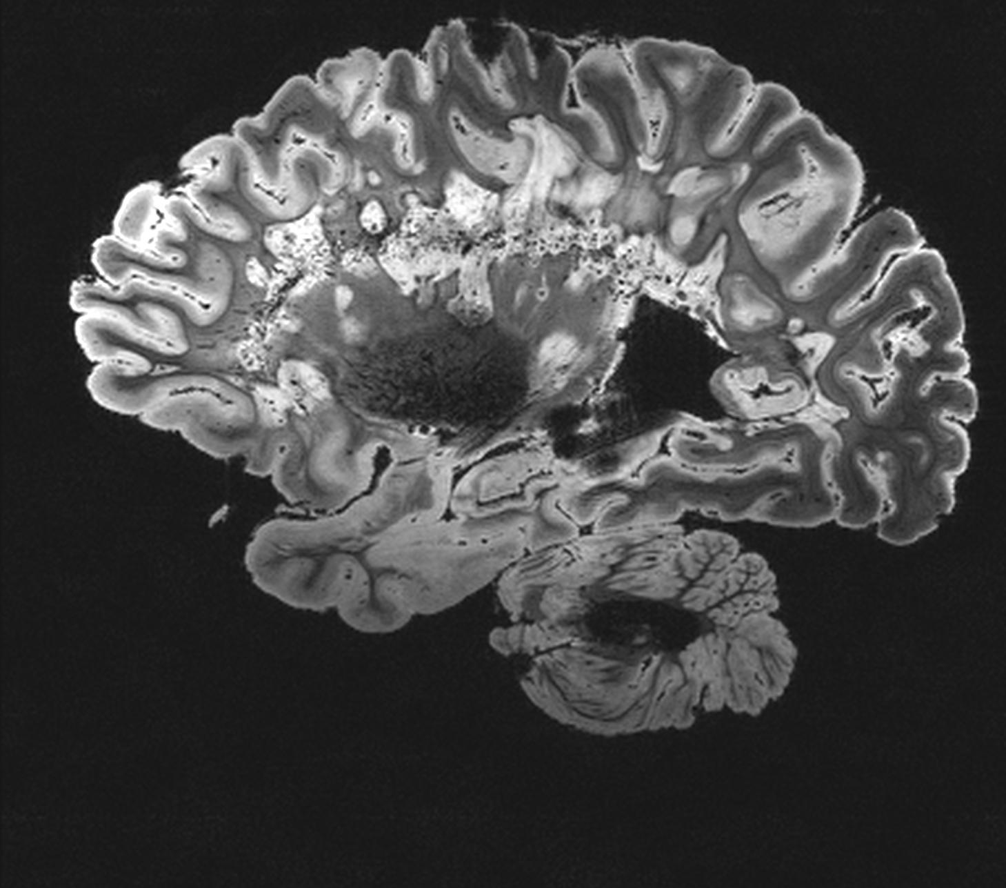 MRI eines Menschen mit multipler Sklerose.